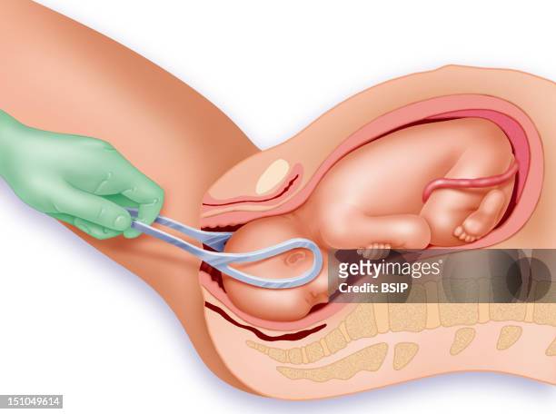 Forceps Assisted Delivery. Illustration Of A Forceps Delivery. In Cases Of Fetal Distress, Forceps May Be Used To Grasp The Baby's Head To Aid In...