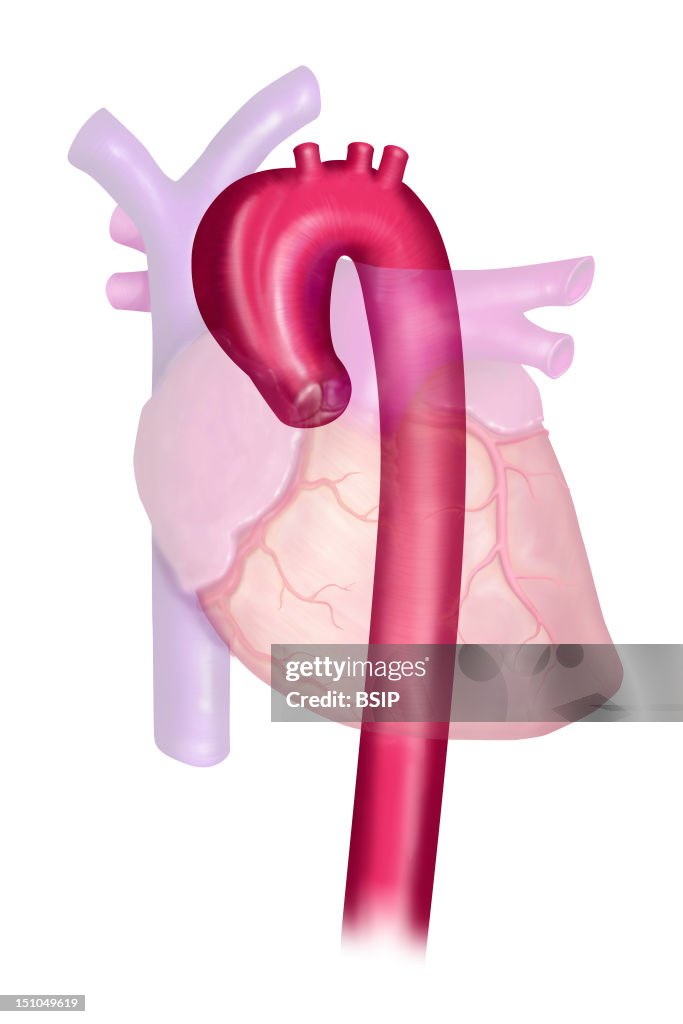 Aneurysm Of The Aortic Arch