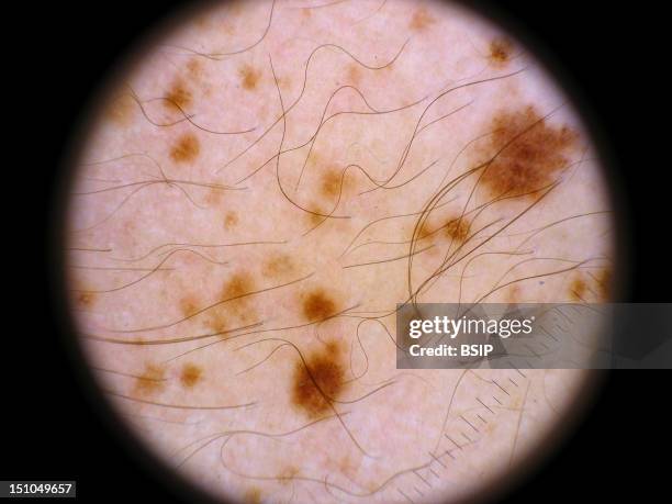 Nevus Spilus. Field Of Naevi, Area Of The Skin That Has The Tendency To Produce Naevus. Image Realized With A Dermatoscope Each Space Of The Scale...