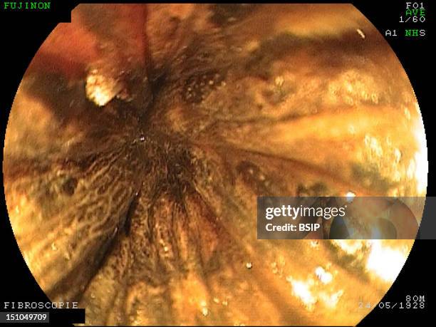 Gastroscopy. Cancer Of The Larynx. Coloration Of The Esophagus With Lugol's Iodine To Highlight The Dysplasias. Chromoendoscopy The Marking With...