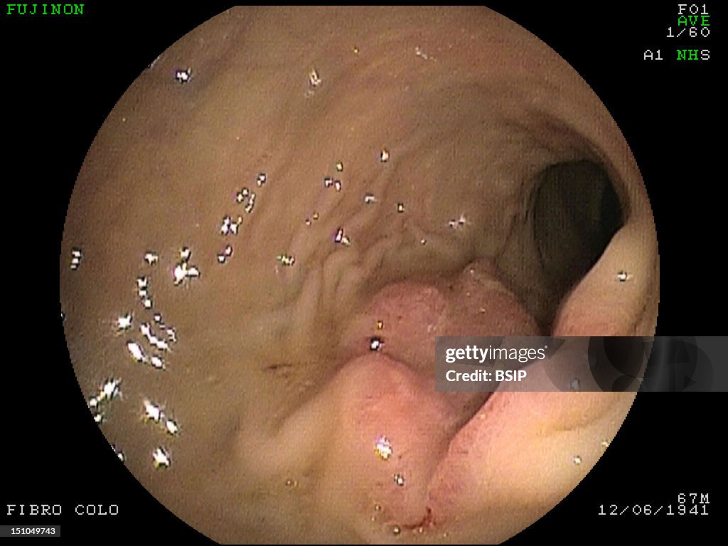 Stomach Atrophy, Endoscopy