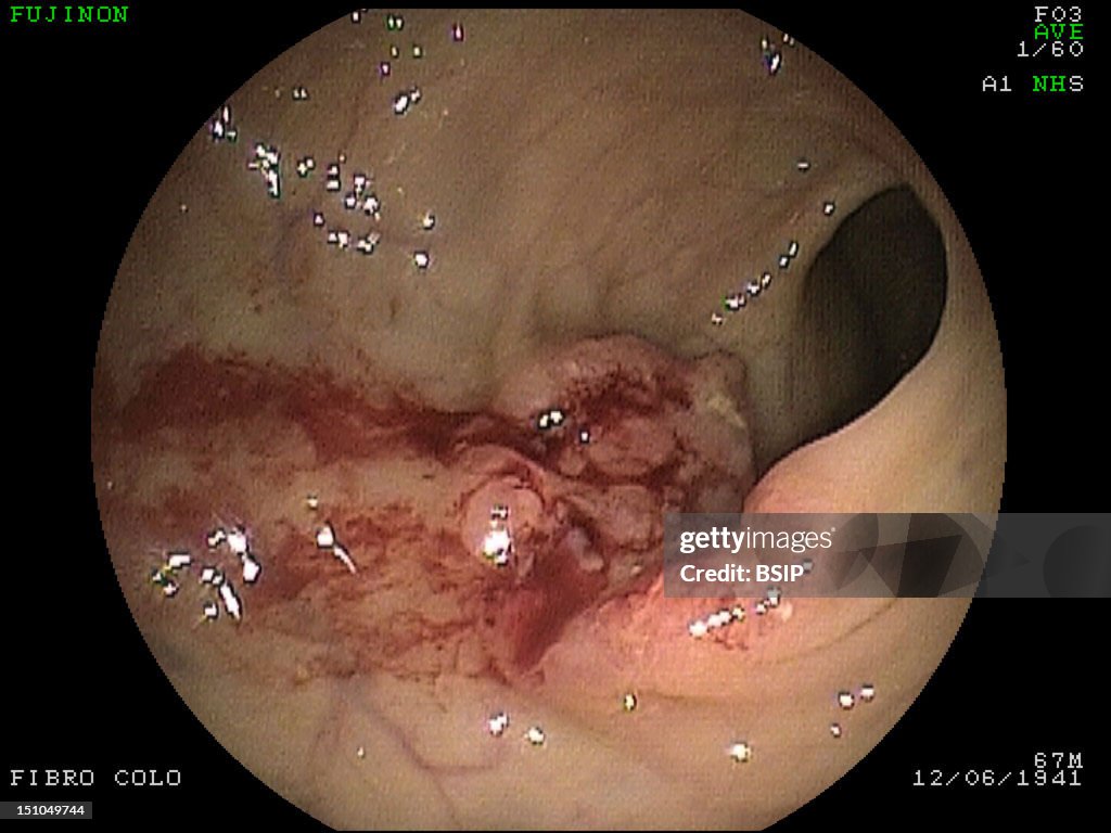Stomach Atrophy, Endoscopy