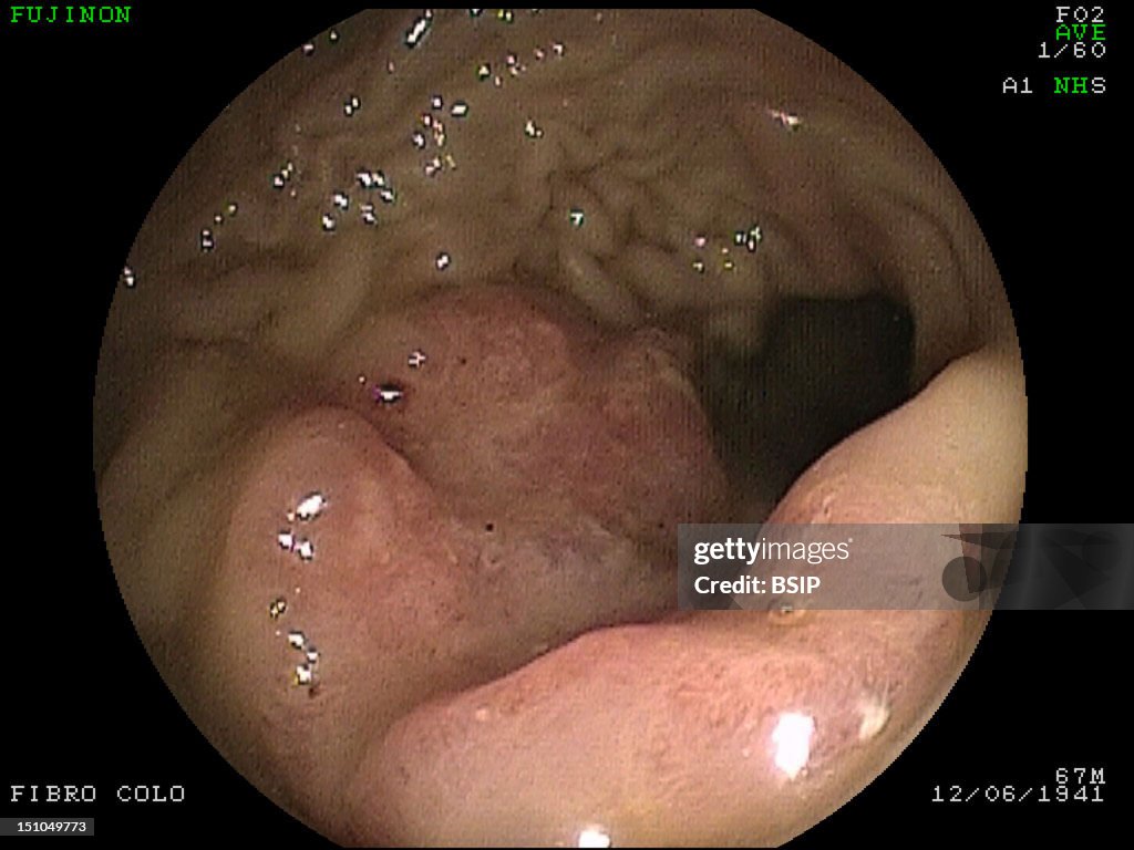 Stomach Atrophy, Endoscopy