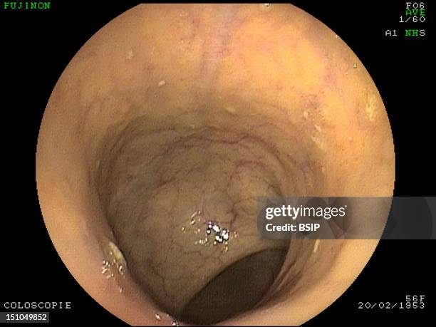 Coloscopy. Intestinum Tenue.