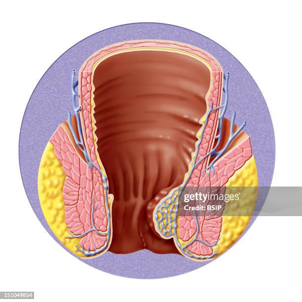 Internal Hemorrhoids. Illustration Of The Internal Hemorrhoidal Plexus And Internal Hemorrhoids.