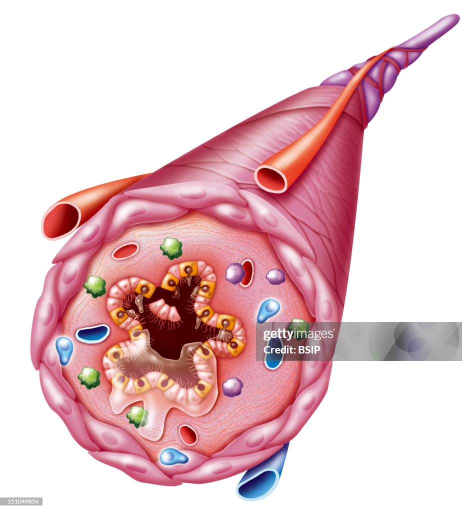 Asthma, Drawing