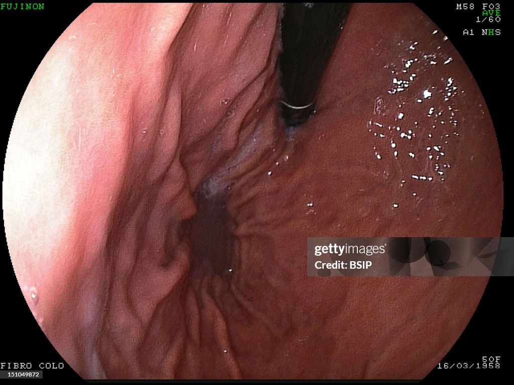 Stomach, Endoscopy Result