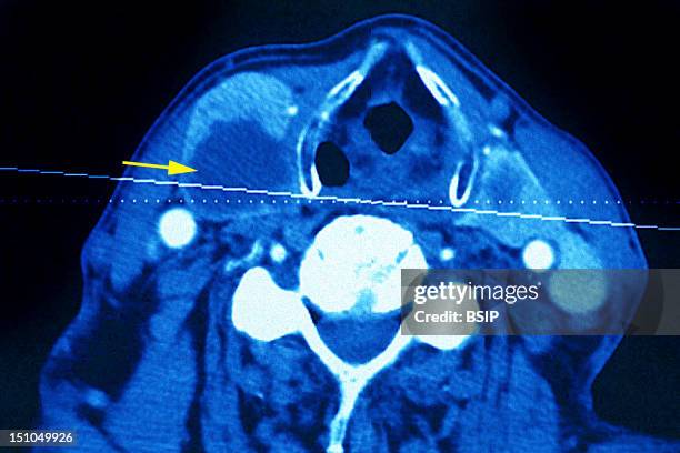Thyroid Carcinoma. Thyroid Tumor. Ct Scan Of Neck.
