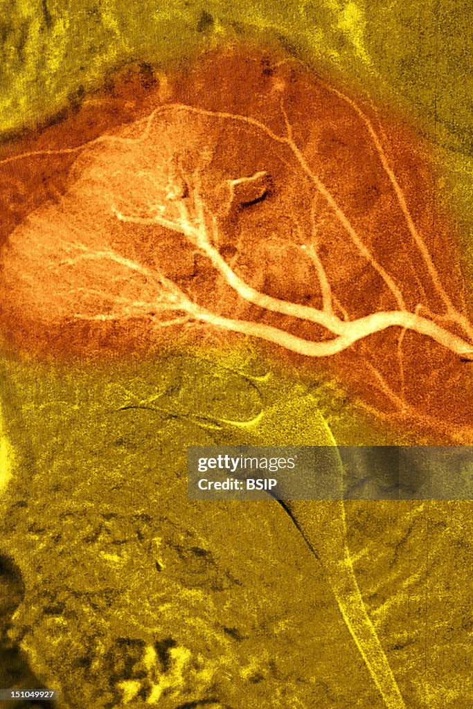 Buerger'S Disease