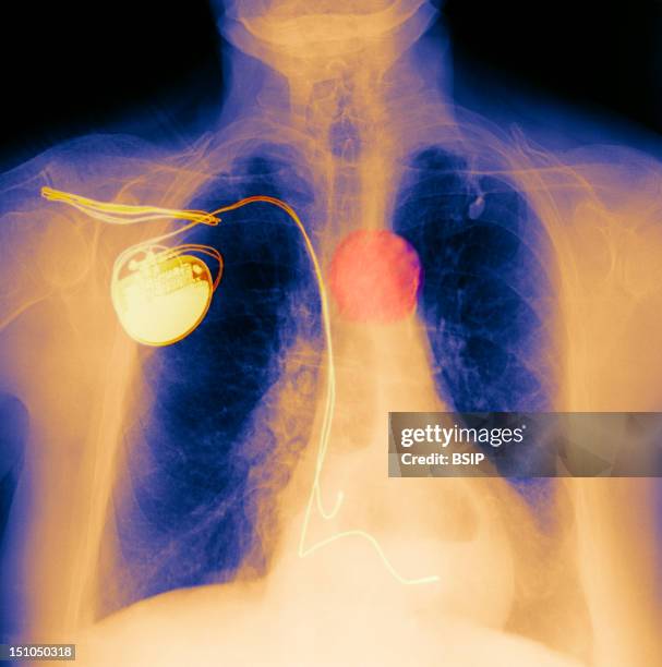 Patient Wearing A Pacemaker, And Affected By A Hiatal Hernia.