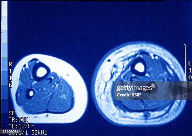 Leg Edema Resolution 156 Edema Legs Stock Photos, High-Res Pictures, and Images - Getty Images