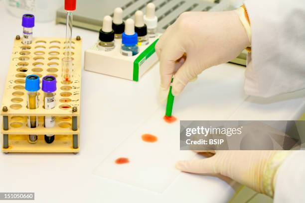 Photo Essay From Laboratory. Determination Of Blood Group Abo On Plate. Research Of Erythrocyte Antigens Abo Grouping. Here, Mix Of The Blood Of A...
