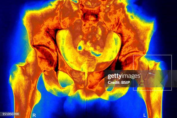 Fractured Left Femur Neck. Osteporosis. X Ray Of Hips, Frontal View.