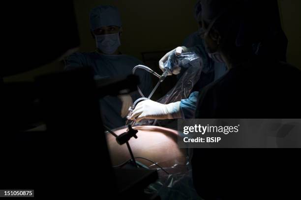 Photo Essay At The Hospital Of Meaux 77, France. Visceral And Digestive Surgery. Surgery Of Obesity Sleeve Gastrectomy Under Laparoscopy.