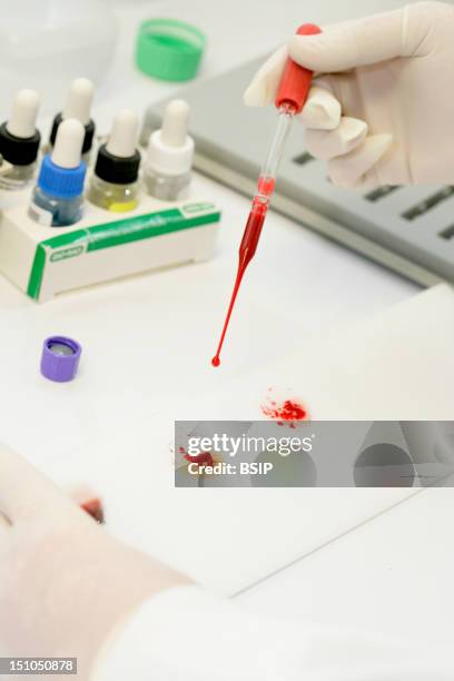 Photo Essay From Laboratory. Determination Of Blood Group Abo On Plate. Research Of Erythrocyte Antigens Abo Grouping. There Is An Agglutination Red...
