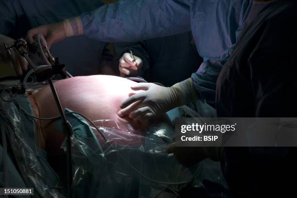 Photo Essay At The Hospital Of Meaux 77, France. Visceral And Digestive Surgery. Surgery Of Obesity Sleeve Gastrectomy Under Laparoscopy.