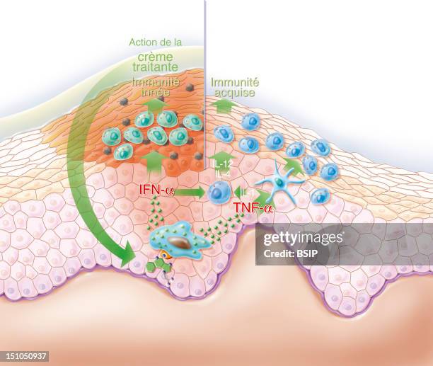 Representation Of The Action Of A Treating Cream On A Wart. The Ointment Contains An Immunomodulator That Will Stimulate The Production Of Cytokines...