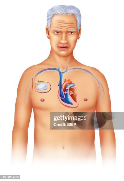 Pacemaker In Chest Pacemaker Ecg Photos and Premium High Res Pictures - Getty Images