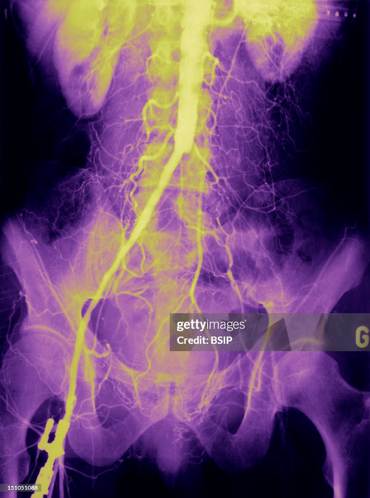 Arterial Thrombosis