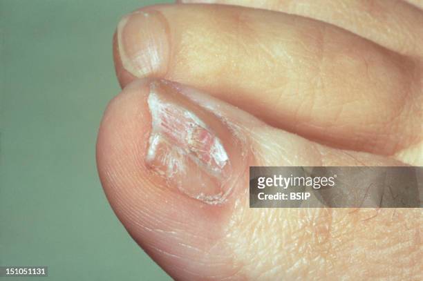 Onchomycosis Mycosis Of The Great Toe Nail.