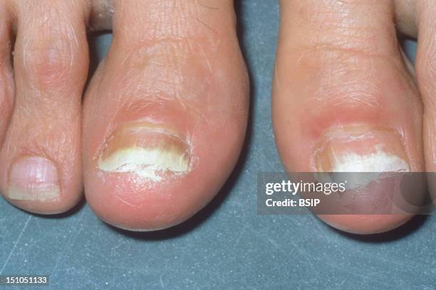 Onchomycosis Mycosis Of The Great Toe Nails.