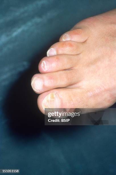Onchomycosis Mycosis Of The Great Toe Nail. Trichophytosis Infection By The Dermatophyte Trichophyton.