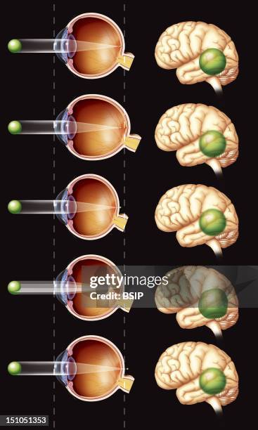 Refractive Eye Disorders. Illustration Of Various Refractive Errors. Comparison Of A Normal Eye, And Eyes With Nearsightedness Myopia, Farsightedness...