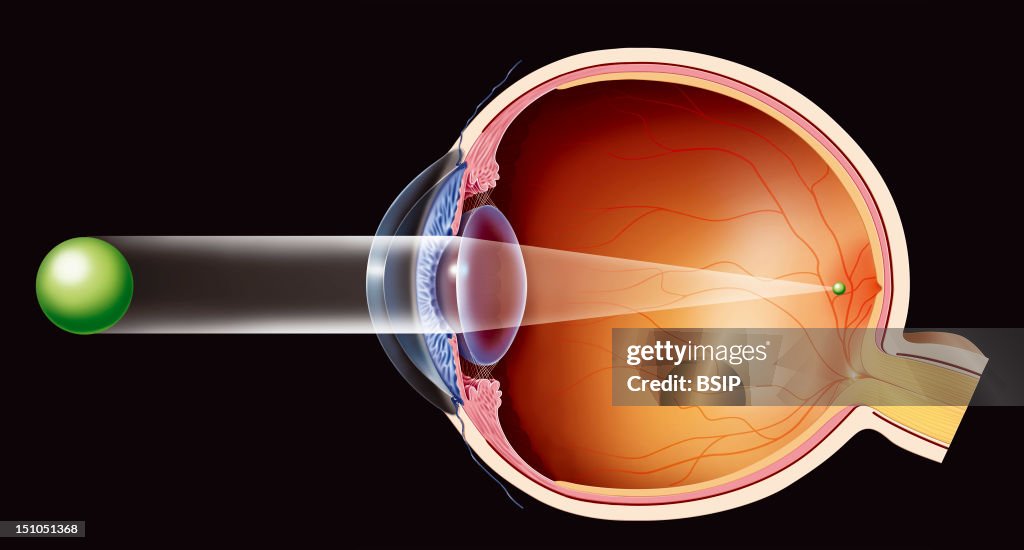 Myopy Illustration Of A Nearsighted Myopic Eye The Eyeball Is Too Long Or ...
