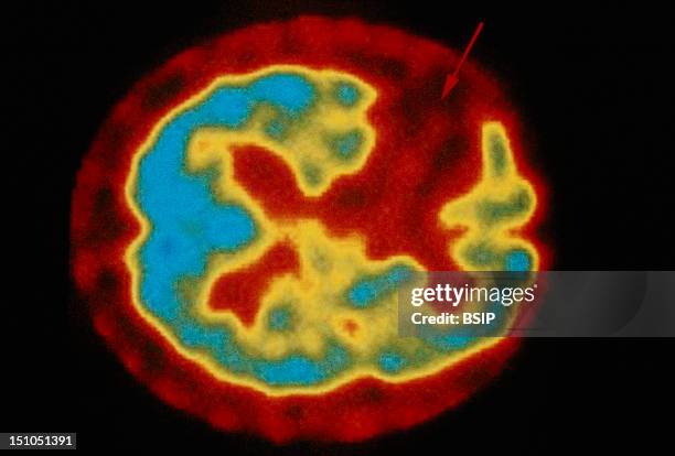 Scintiscan Of The Brain, Axial View.