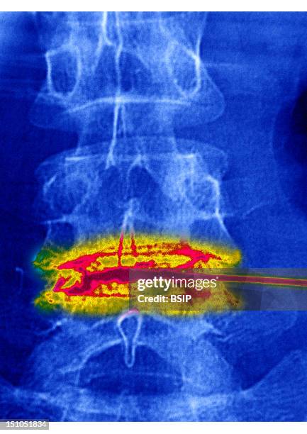 Disc Space Injection 53 Lumbar Injection Stock Photos, High-Res Pictures, and Images - Getty ...