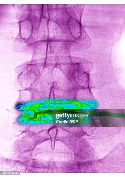 Disc Space Injection Lumbar Injection Photos and Premium High Res Pictures - Getty Images