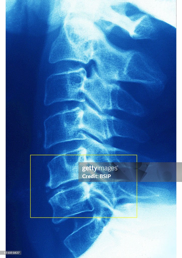 Cervical Osteoarthritis, X-Ray