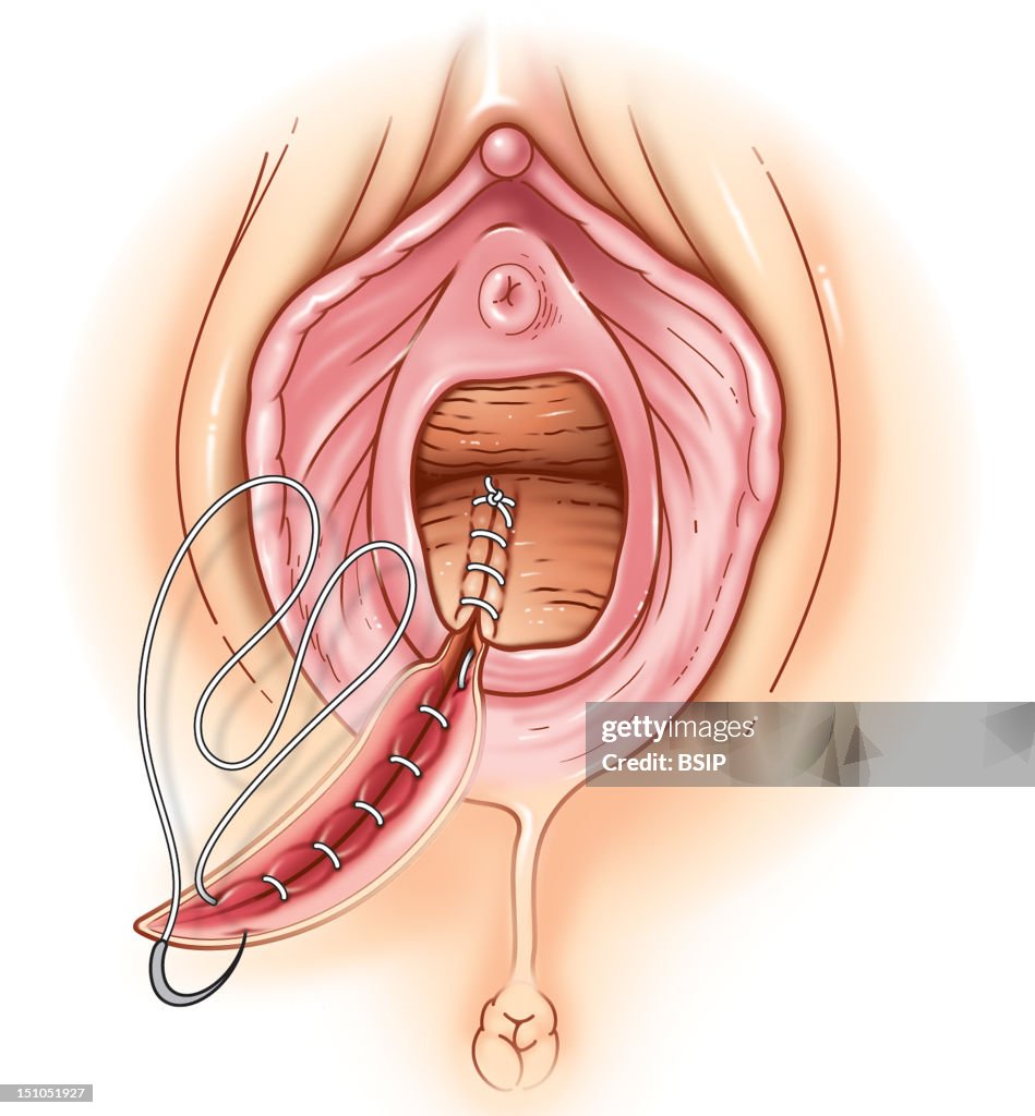 Episiotomy