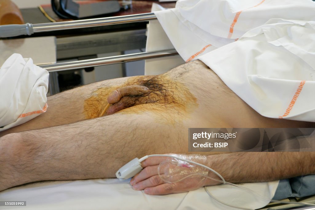 Cancer Of Prostate Ultrasound