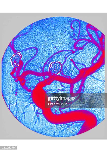 Endovascular Occlusion Of Two Cerebral Artery Aneurisms Obtained Using Detachable Metal Coils Which, Once Positioned In The Aneurisms, Are Released...