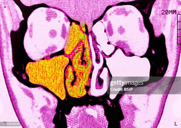 Sinusitis Of The Maxillary Sinus And The Right Meatus. Cranial Scan, Frontal Cross Sectional View.