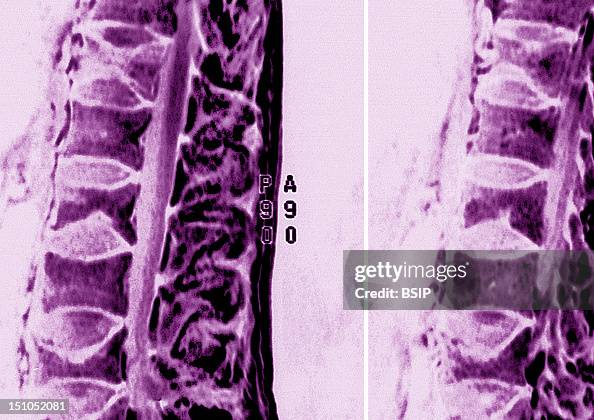 Compression Fracture, Mri Compression Fracture, Mri