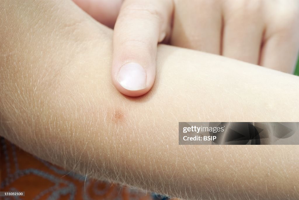 Insect Bite