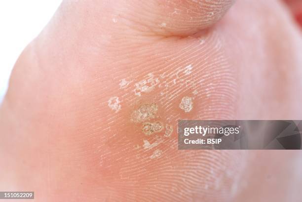 Images Of Plantar Warts Photos And Premium High Res Pictures Getty Images images-of-plantar-warts-photos-and-premium-high-res-pictures-getty-images