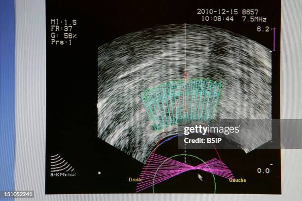 Ablatherm Hifu Is A Non Invasive Medical Device Which Uses Hifu High Intensity Focused Ultrasound To Treat Localised Contained Prostate Cancer. The...