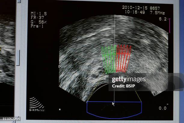 Ablatherm Hifu Is A Non Invasive Medical Device Which Uses Hifu High Intensity Focused Ultrasound To Treat Localised Contained Prostate Cancer. The...