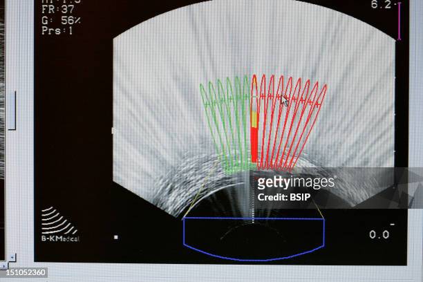 Ablatherm Hifu Is A Non Invasive Medical Device Which Uses Hifu High Intensity Focused Ultrasound To Treat Localised Contained Prostate Cancer. The...