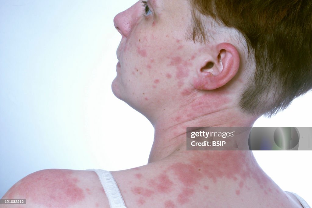 Allergy, Woman