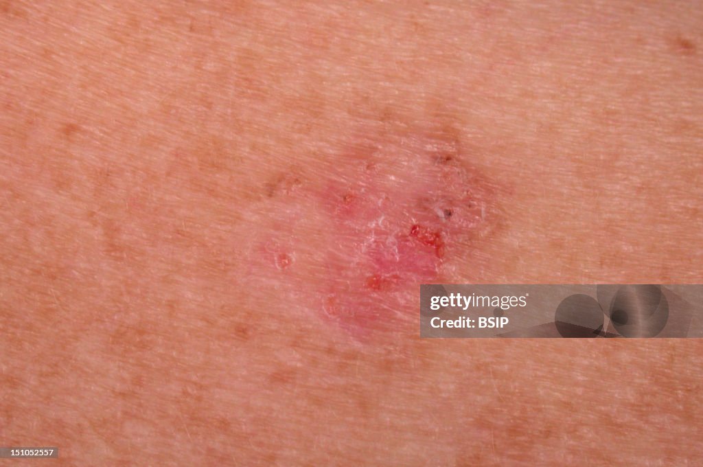 Basal Cell Carcinoma