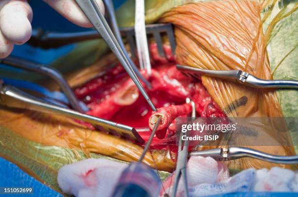 Photo Essay From Hospital. Photo Essay At Alleray Labrouste Clinic, Paris, France. Department Of Vascular Surgery. Operating Room. Carotid...