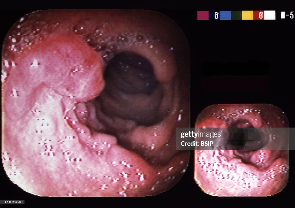 Cancer Of The Colon, Endoscopy