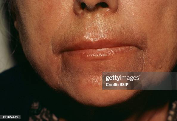 Brochitis Rash Brocq's Pigmented Peri Buccal Dermatitis. News Photo - Getty Images