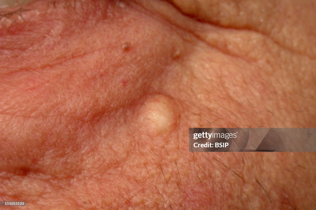 Sebaceous Cyst