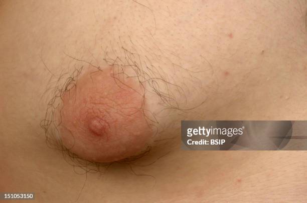 Gynecomastia On A 15 Year Old Boy.