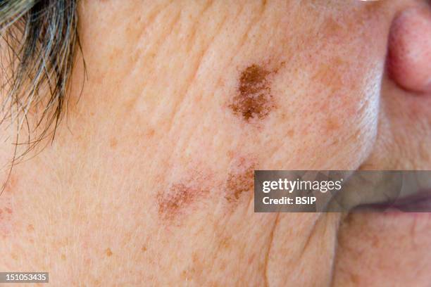 Lentigo Senilis Old Age Spot After Cryotherapy Carbonic Snow.